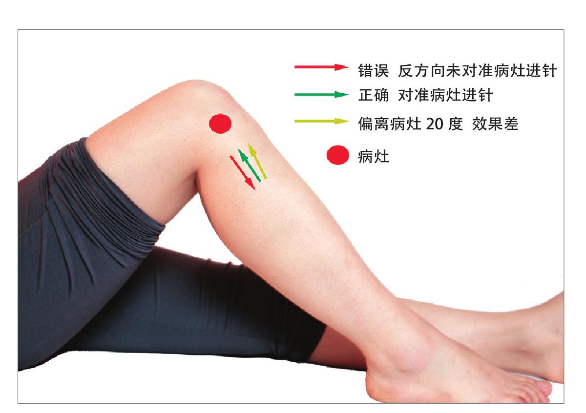 二、套針療法特點(diǎn)
