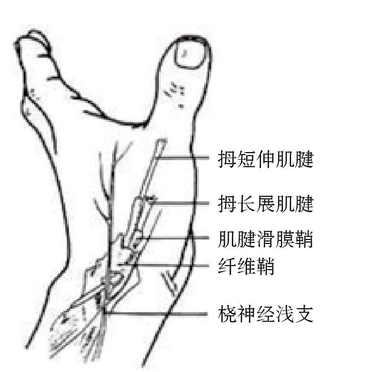 第三節(jié) 橈骨莖突狹窄性腱鞘炎