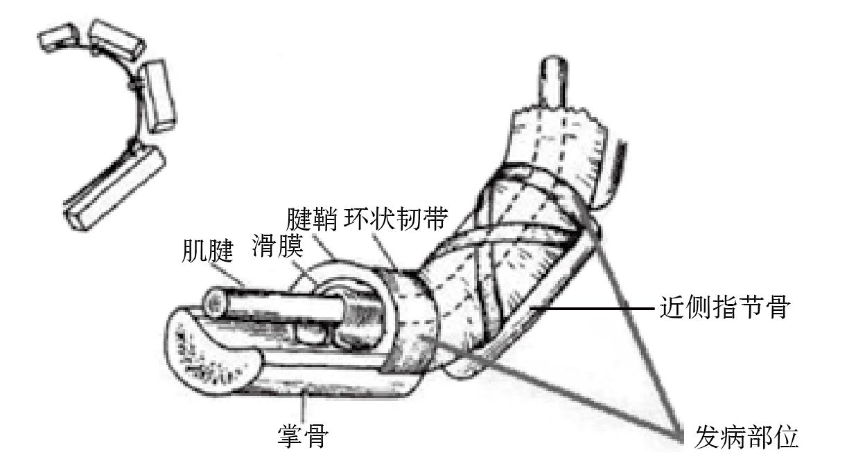 第四節(jié) 手指屈肌腱腱鞘炎