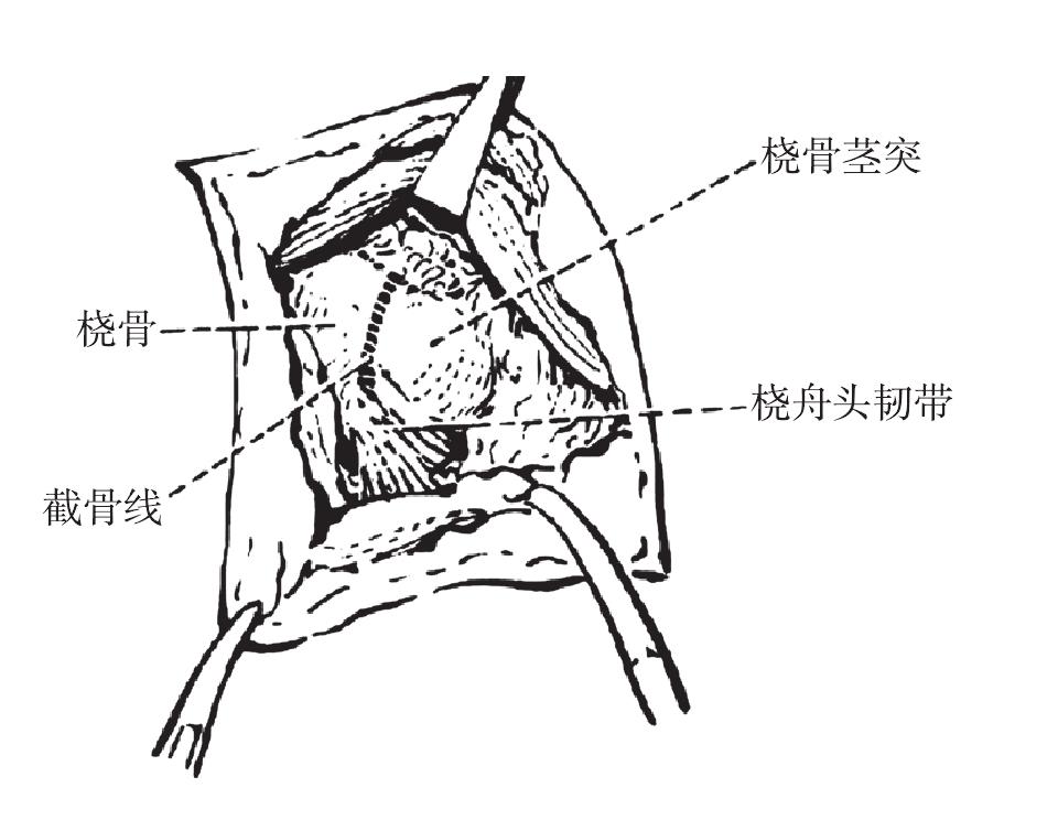 二、舟狀骨骨折截骨掌側(cè)入路植骨克氏針固定術(shù)