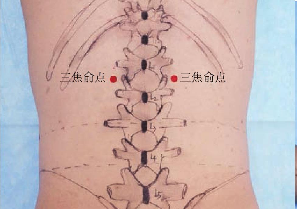 A.31 風五針