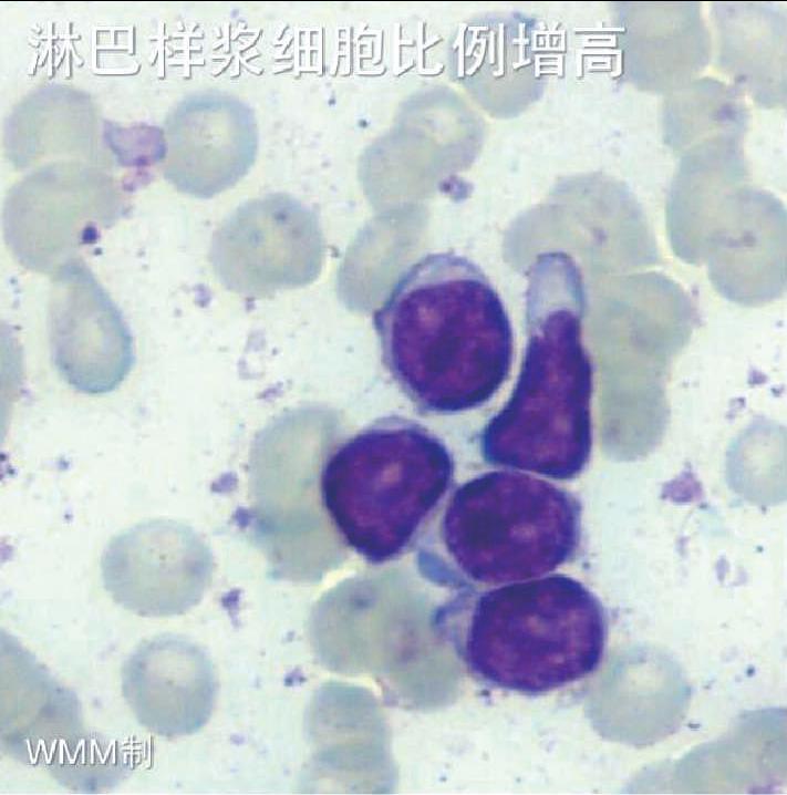 淋巴樣漿細(xì)胞(LPL/WM)淋巴瘤