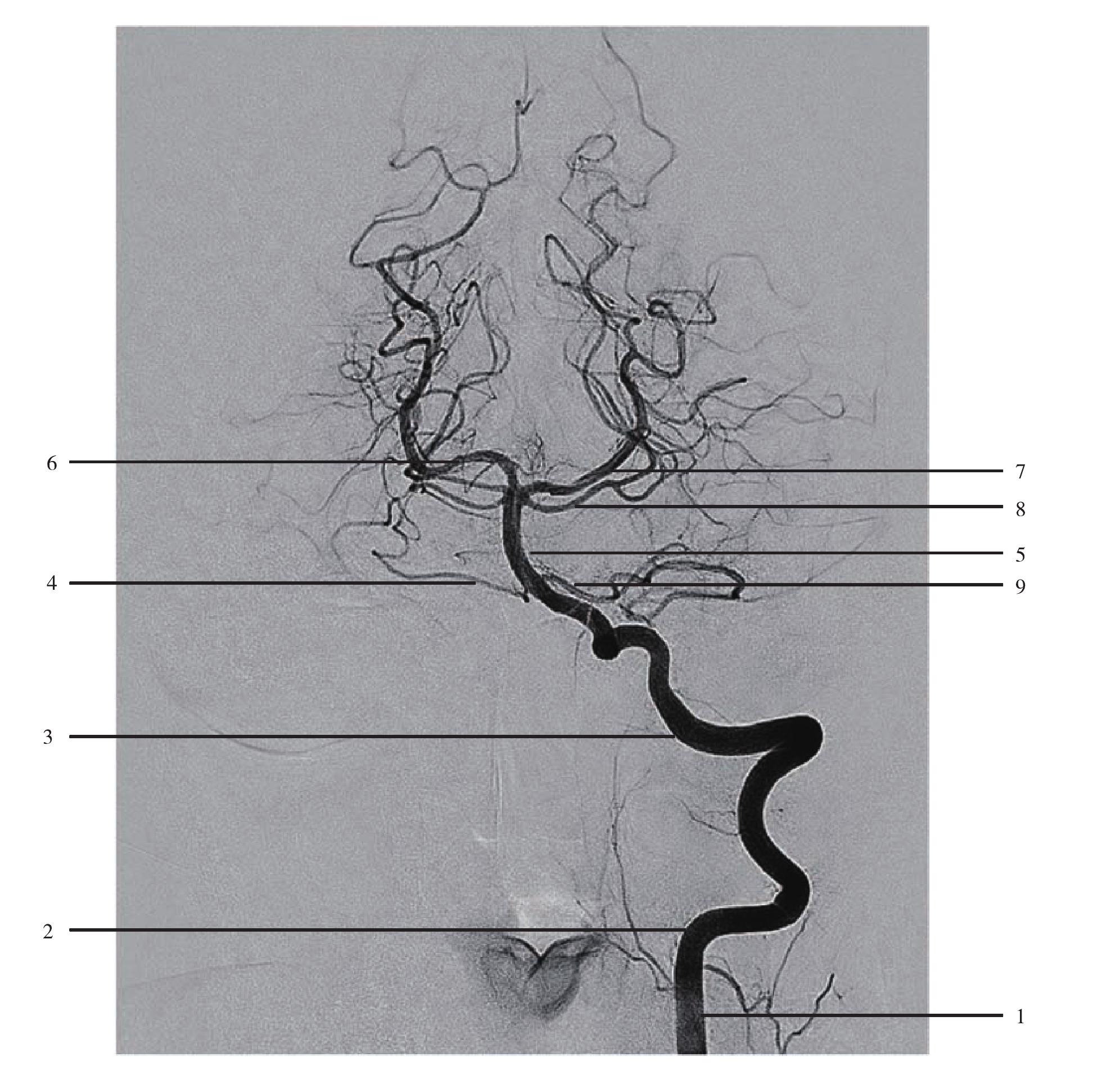 图1-42  椎基底动脉血管造影(正位)