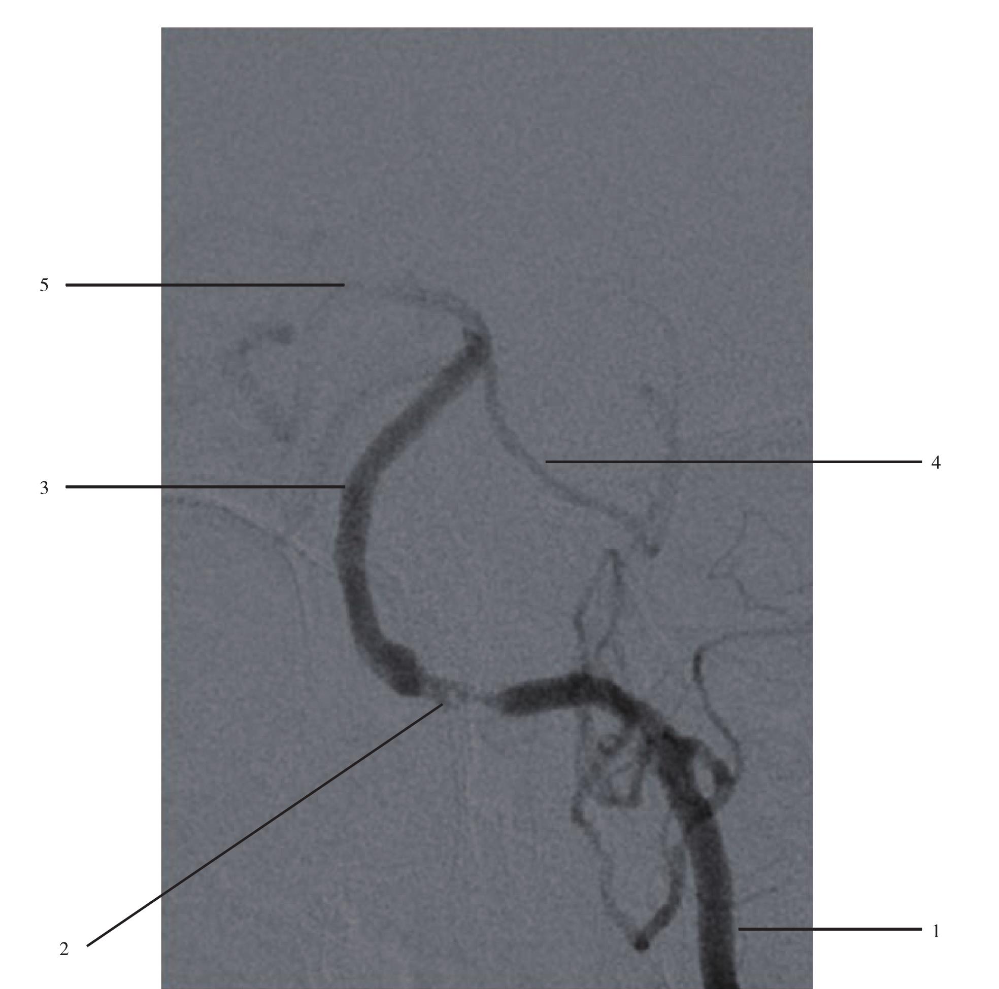 图1-45  椎基底动脉狭窄