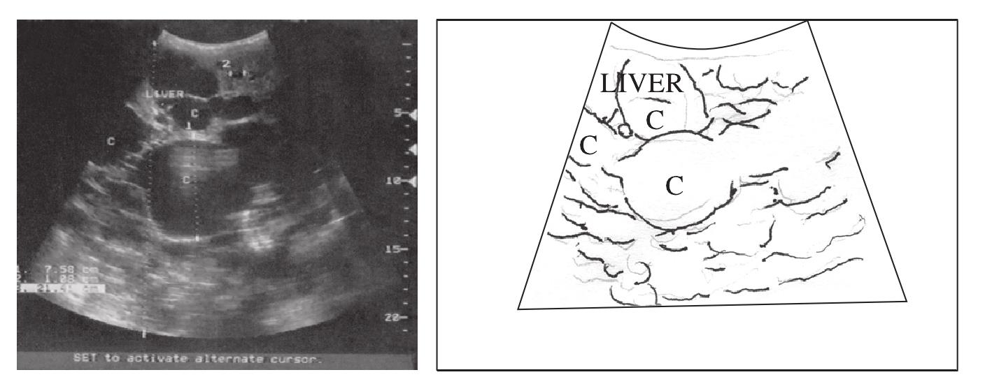 二、多囊肝声像图