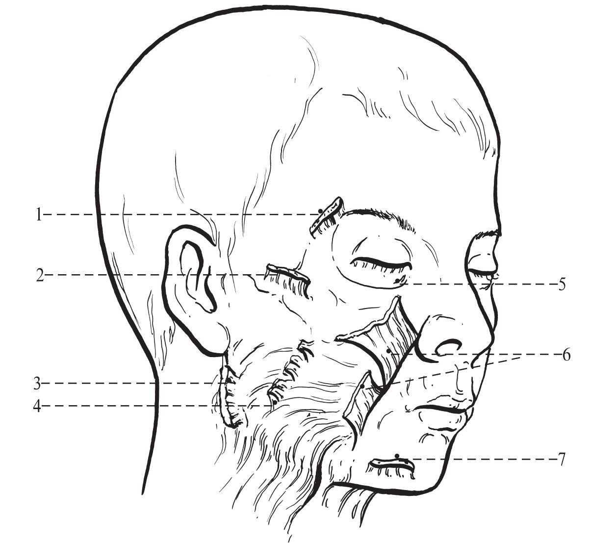 二、面部除皺手術(shù)相關(guān)解剖結(jié)構(gòu)