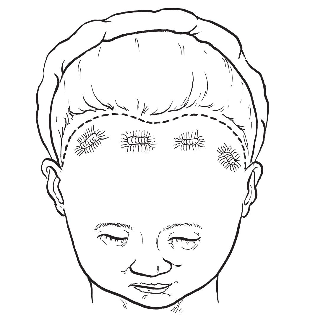 一、額部除皺術(shù)