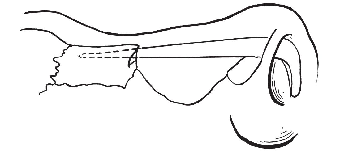 一、隆鼻術(shù)