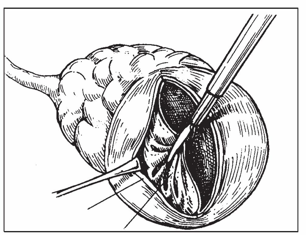 34 卵巢囊腫剔除術(shù)之三:腹腔鏡手術(shù)