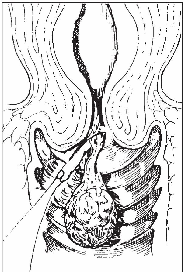41 經(jīng)陰道子宮黏膜下肌瘤去除術(shù)