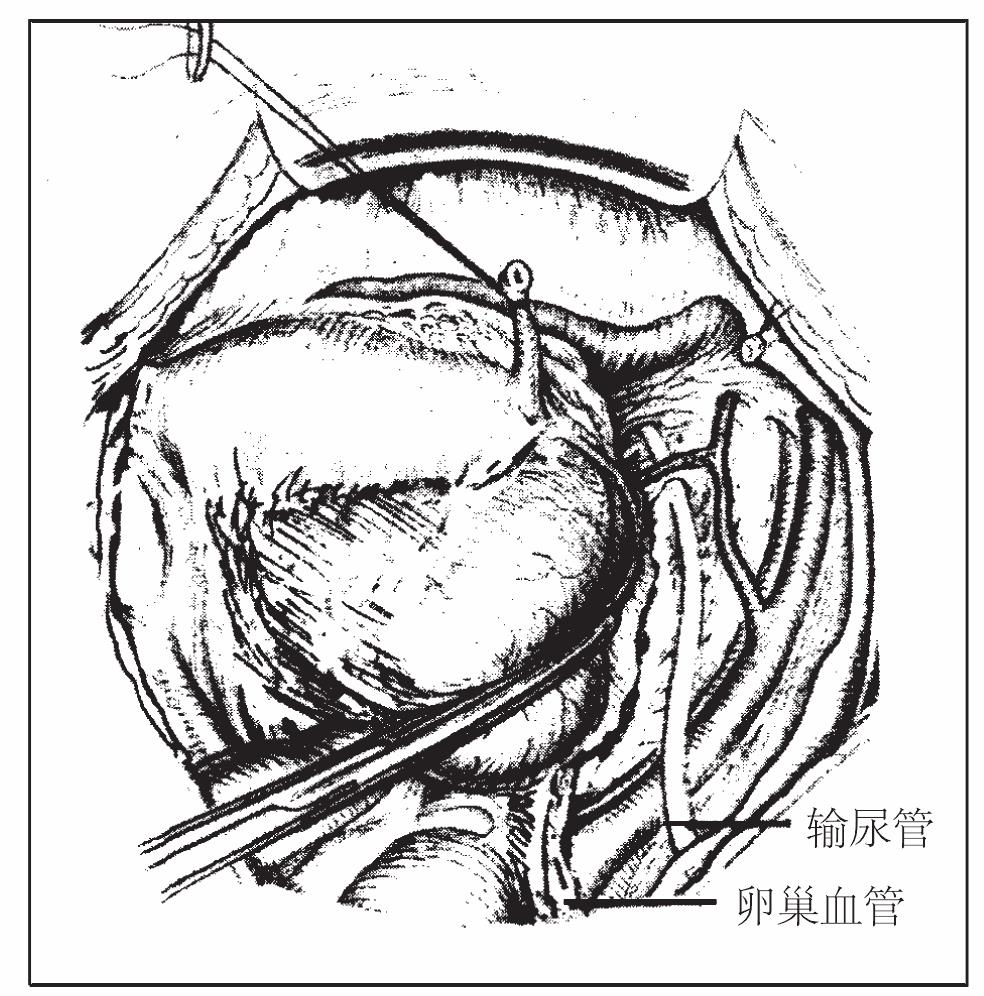 44 腹膜后——你可利用的空間