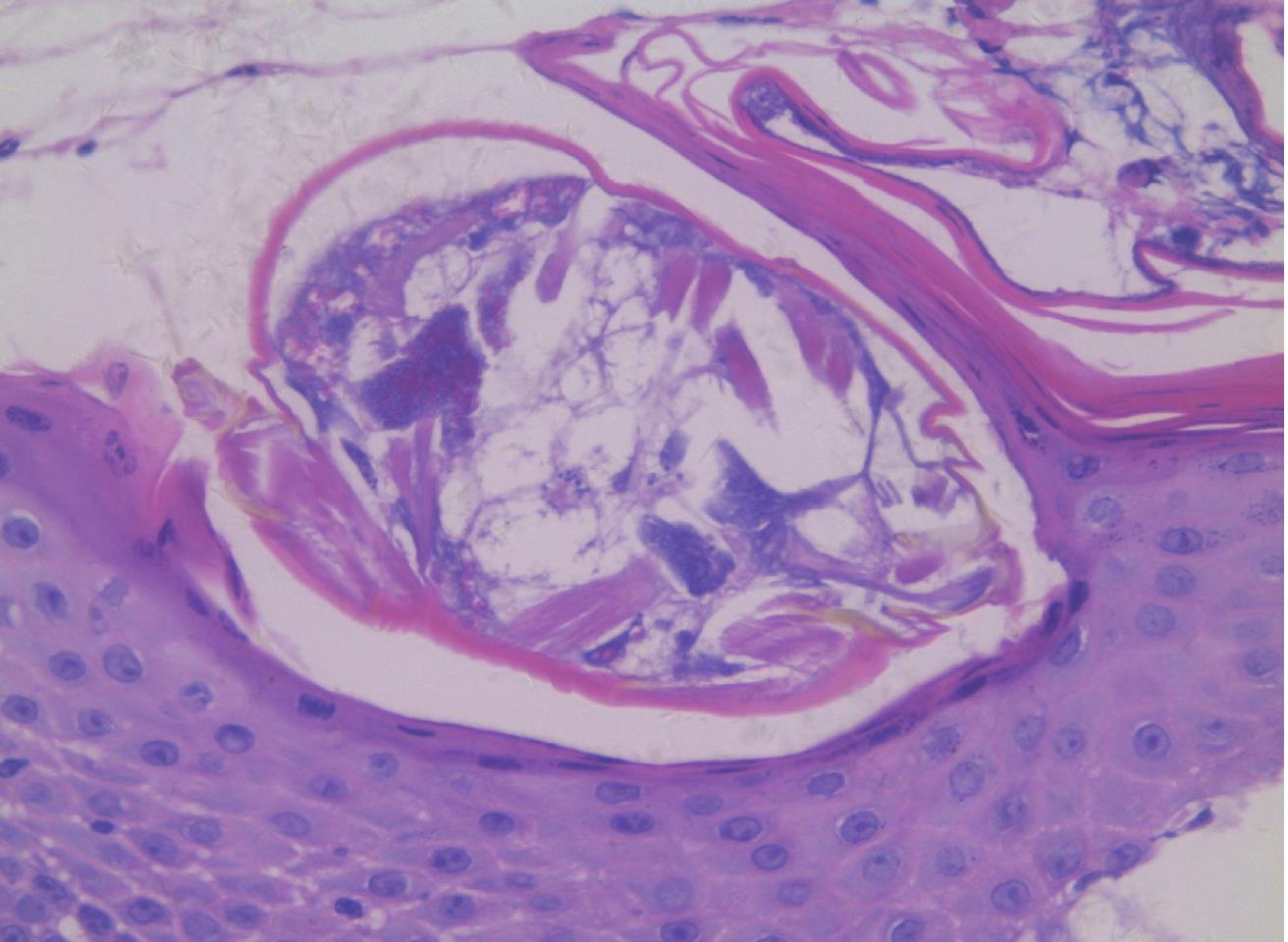6.Scabies