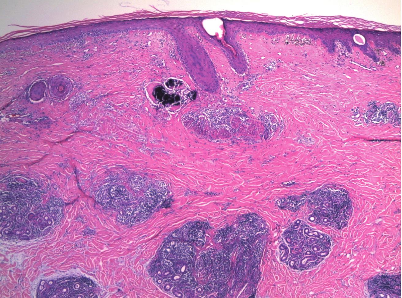 4.Discoid Lupus Erythematosus (DLE)