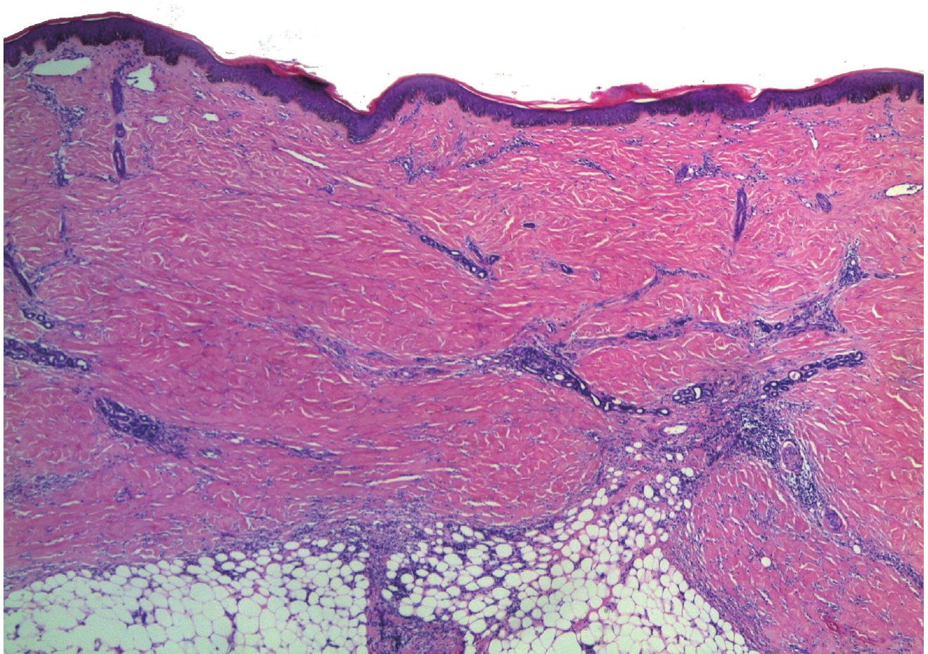 6.Scleroderma