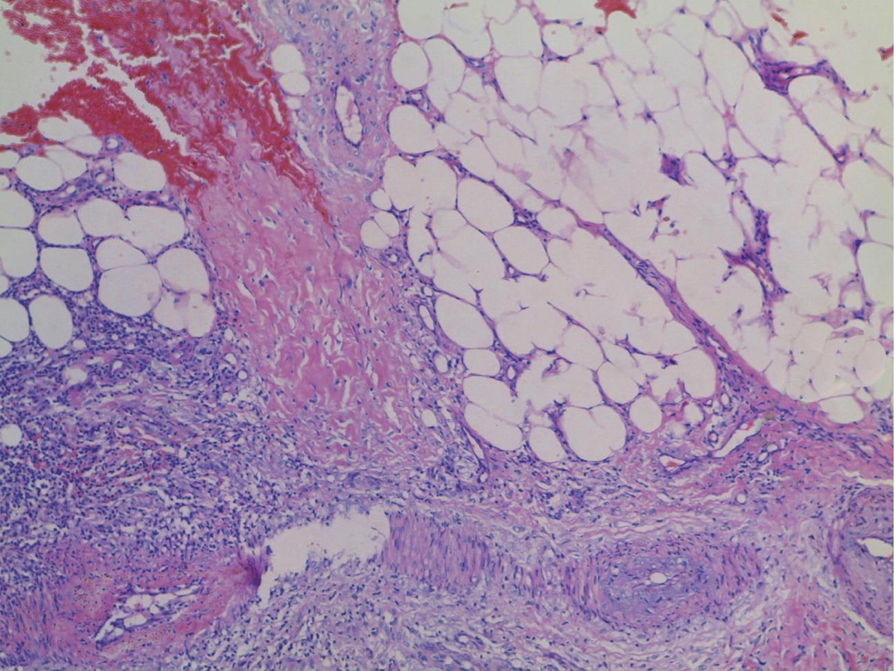 9.Erythema Nodosum