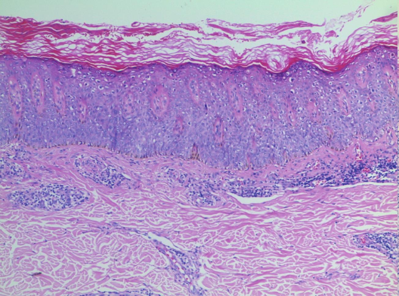 3.Bowen’s Disease (Squamous Cell Carcinoma in Situ)