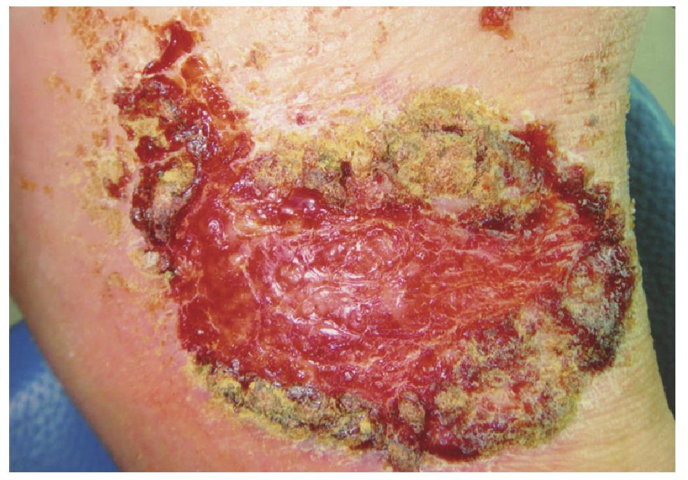 36.惡性腫瘤