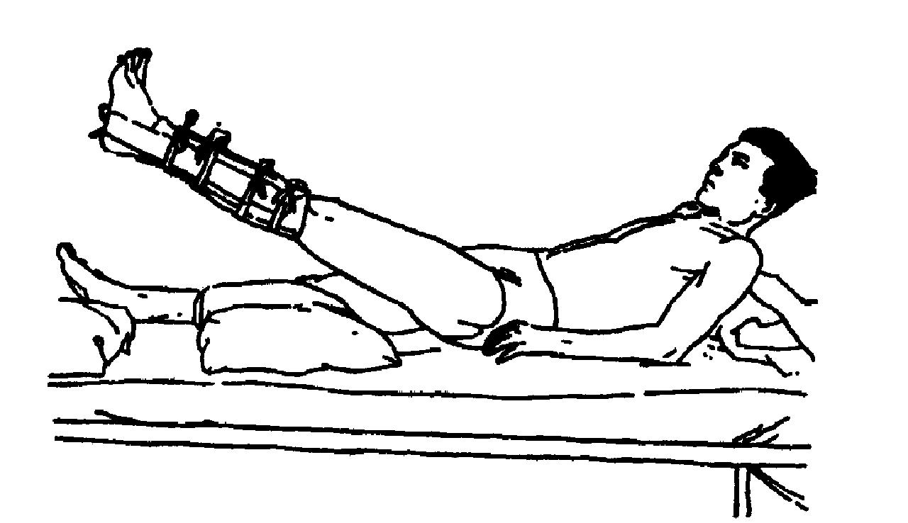 42.脛腓骨骨折患者怎樣進(jìn)行下肢康復(fù)治療?