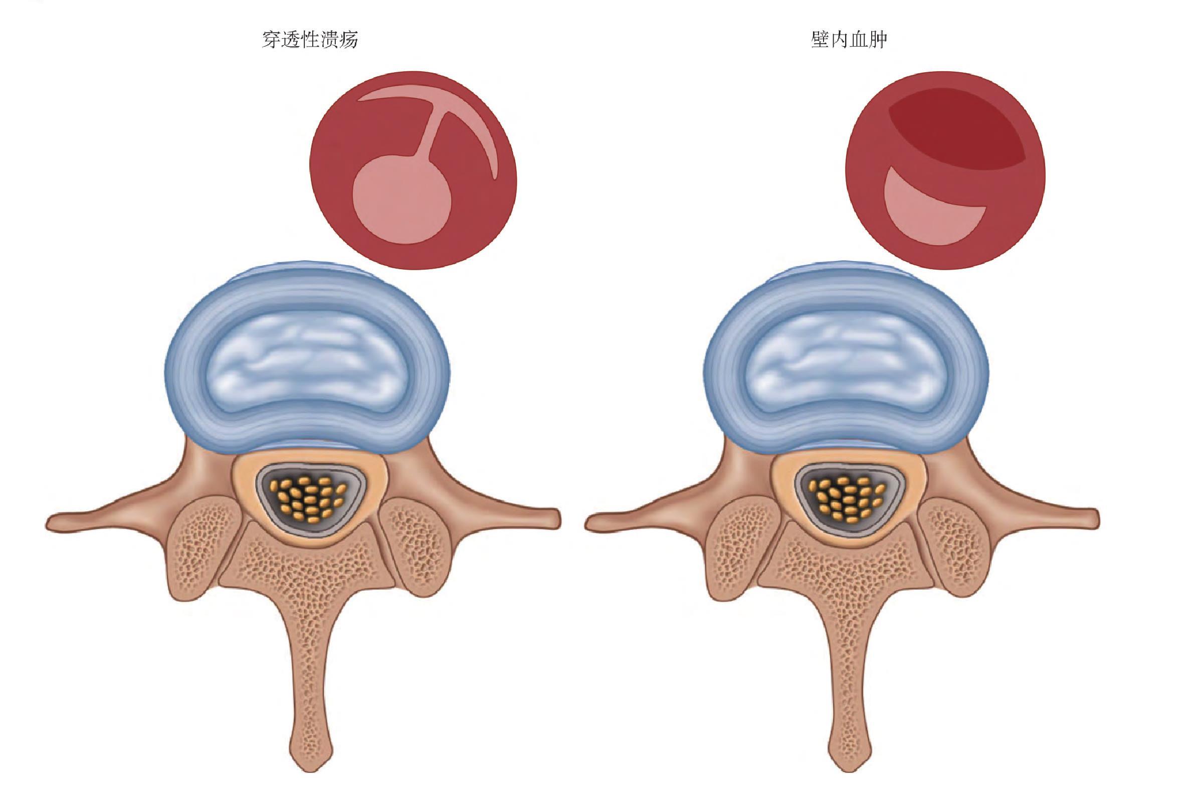 三、壁內(nèi)血腫