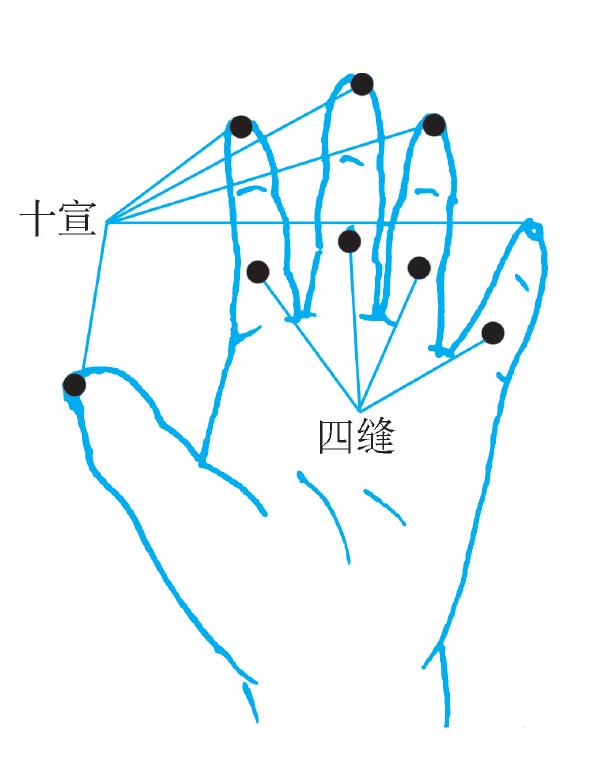(三)四肢經(jīng)外奇穴