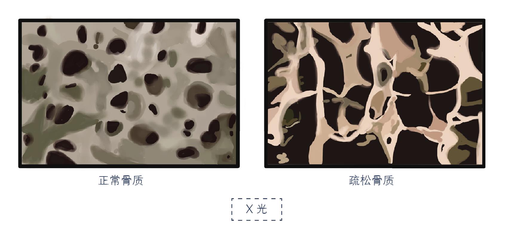 (二)骨影像學(xué)檢查和骨密度檢查可輔助診斷骨質(zhì)疏松