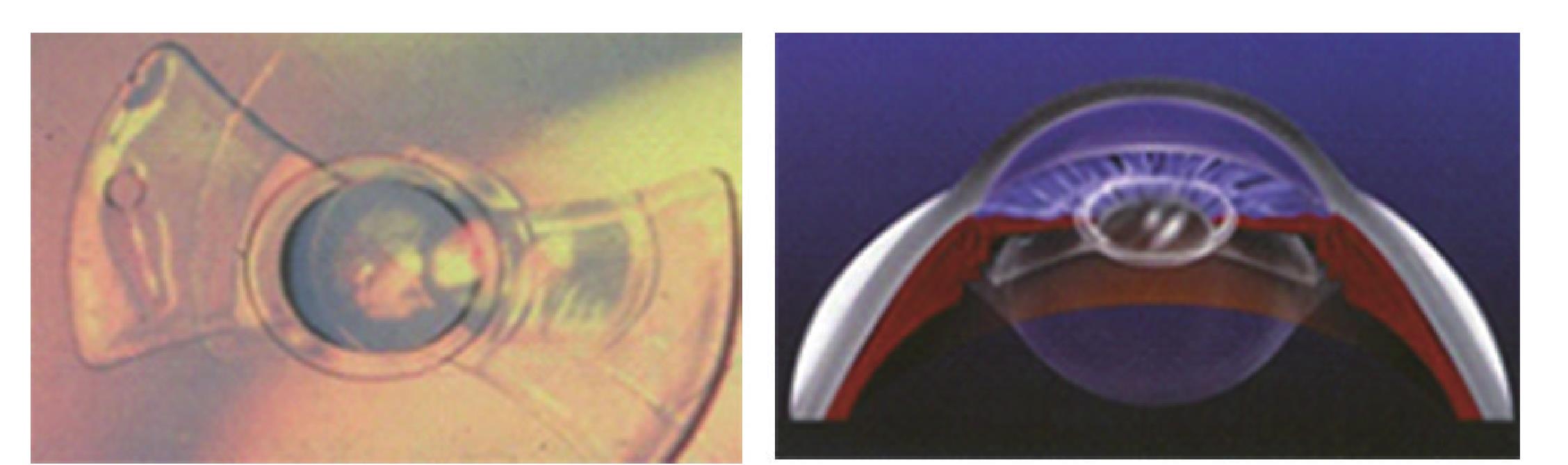 1 后房型有晶状体眼人工晶体的发展史及最新进展