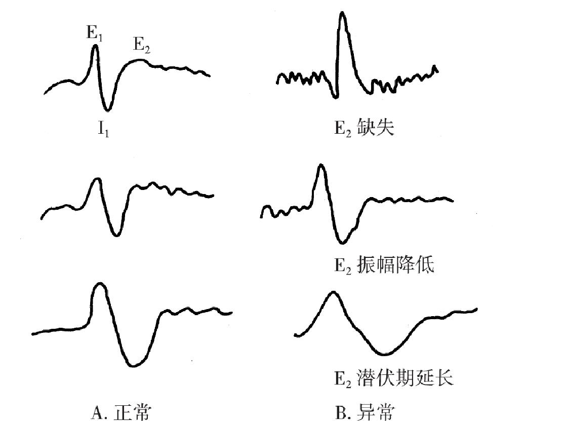 四、腦癱的輔助檢查