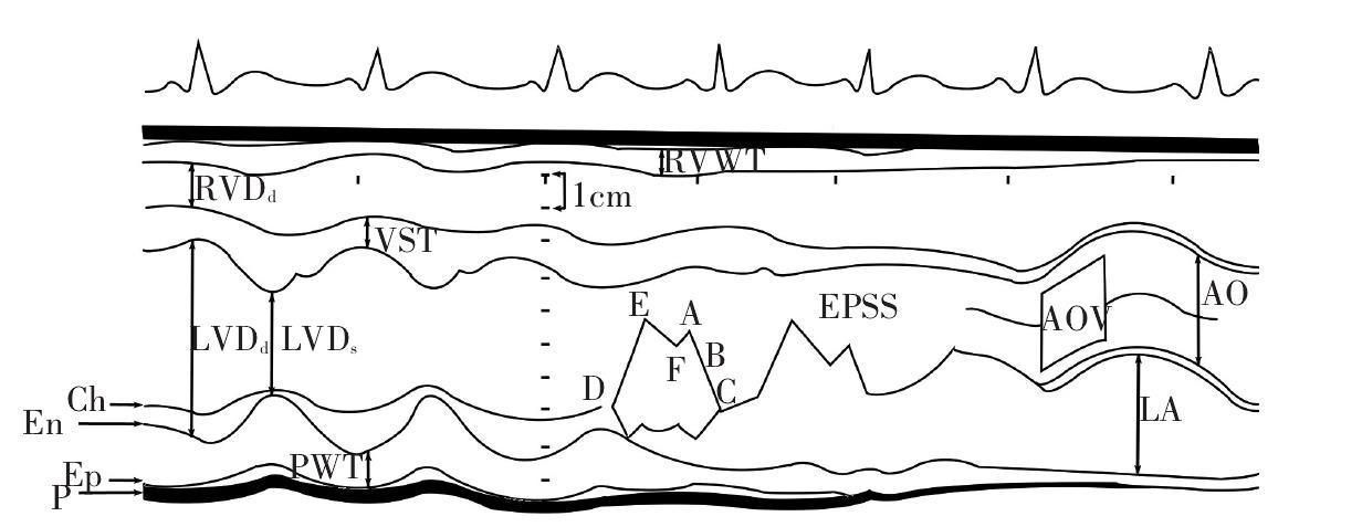 一、M型超声心动图